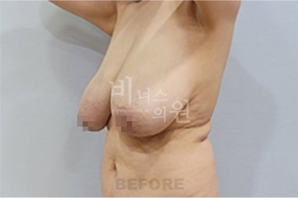 가슴축소 지방흡입 수술 전 측면 비교 1
