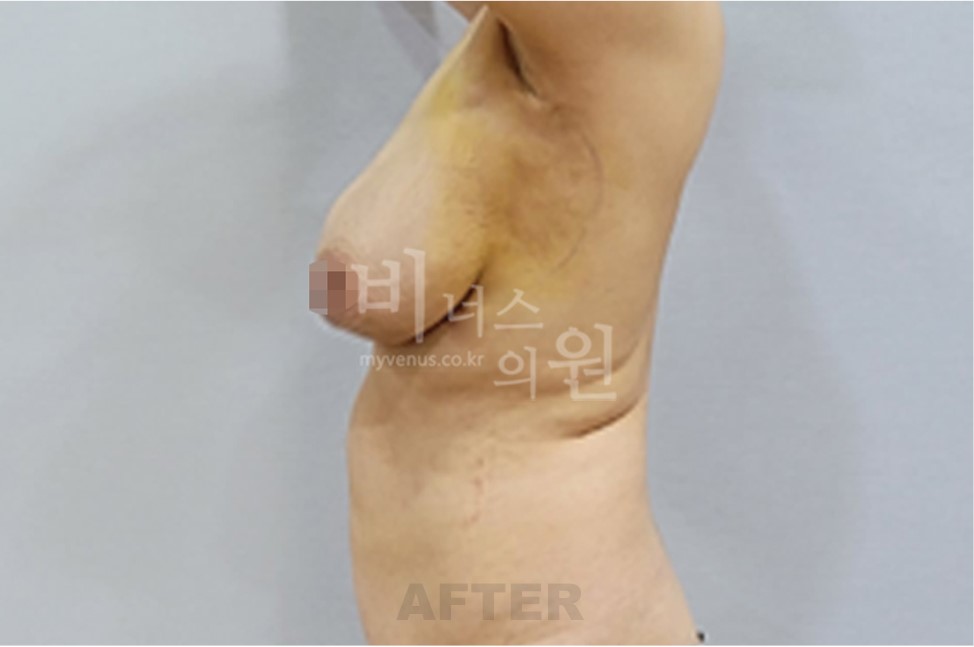 가슴축소 지방흡입 수술 후 측면 비교 2