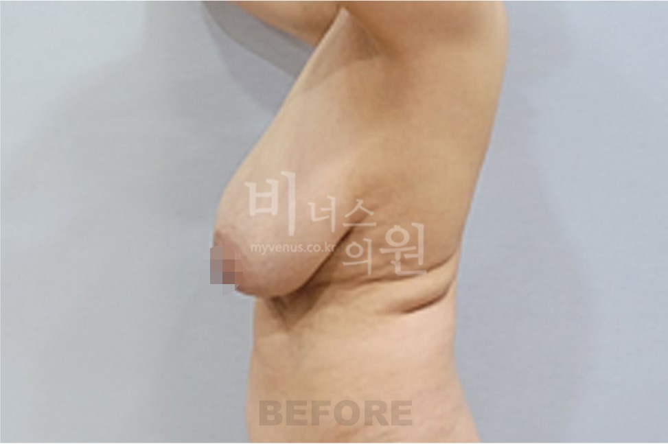 가슴축소 지방흡입 수술 전 측면 비교 2