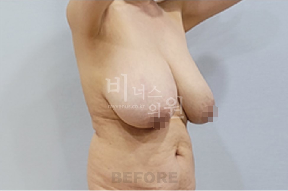 가슴축소 지방흡입 수술 전 측면 비교 3
