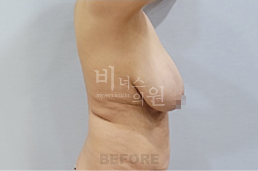 가슴축소 지방흡입 수술 전 측면 비교 4