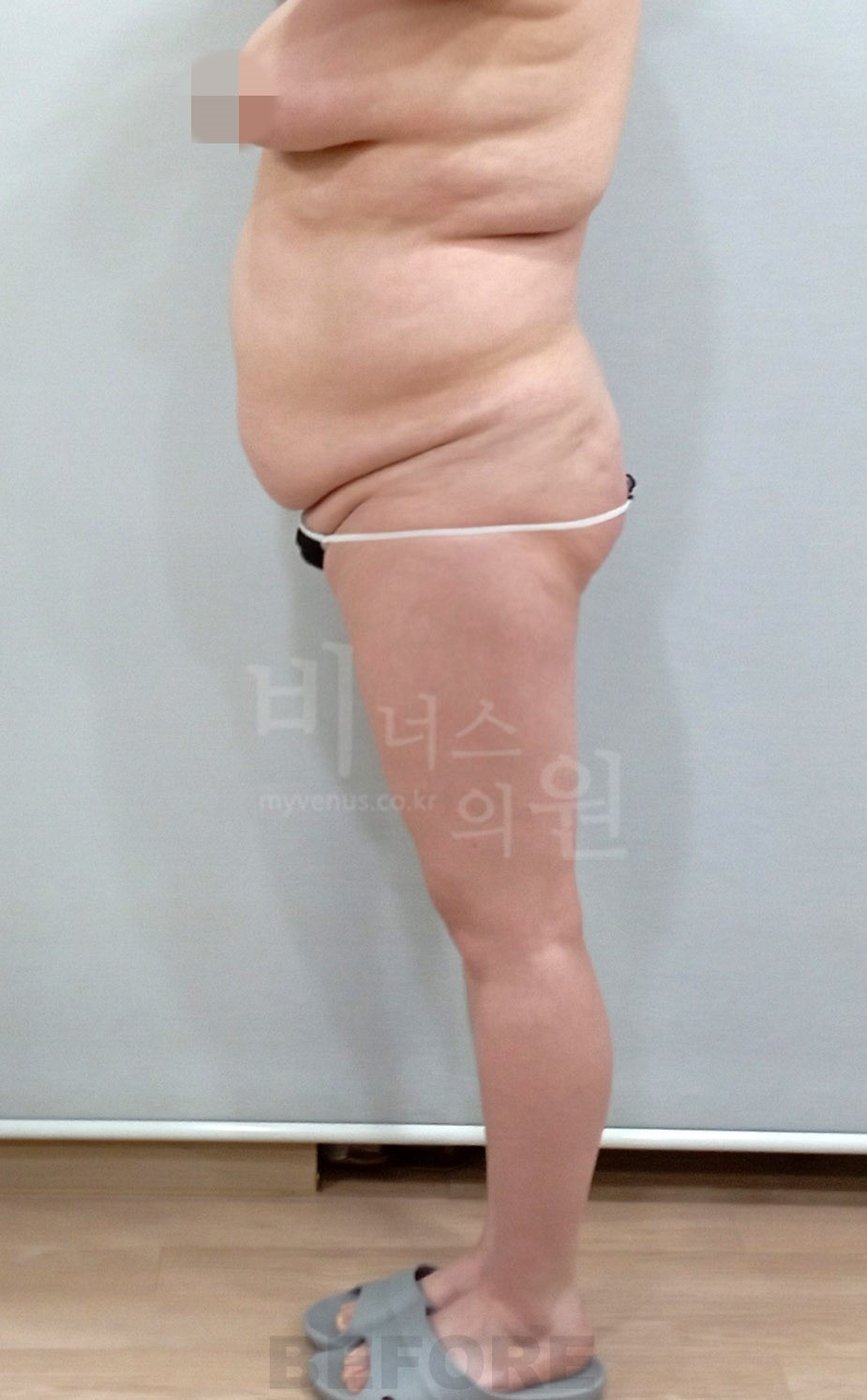복부 허리 엉덩이 지방흡입 수술 전 우측면