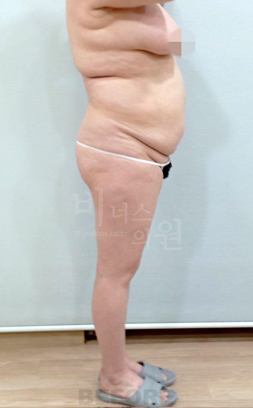 복부 허리 엉덩이 지방흡입 수술 전 좌측면