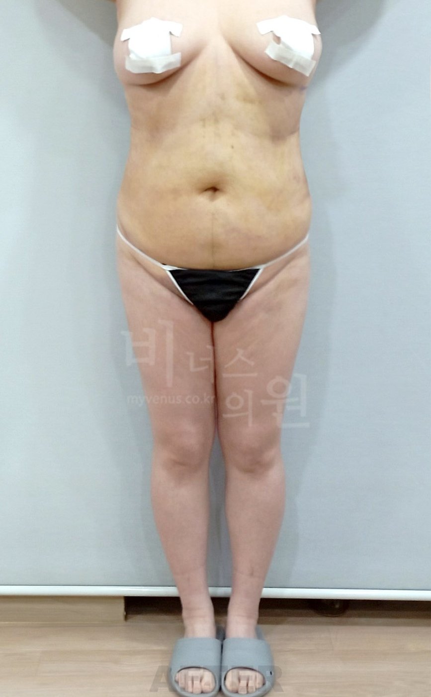 복부 허리 엉덩이 지방흡입 수술 후 정면
