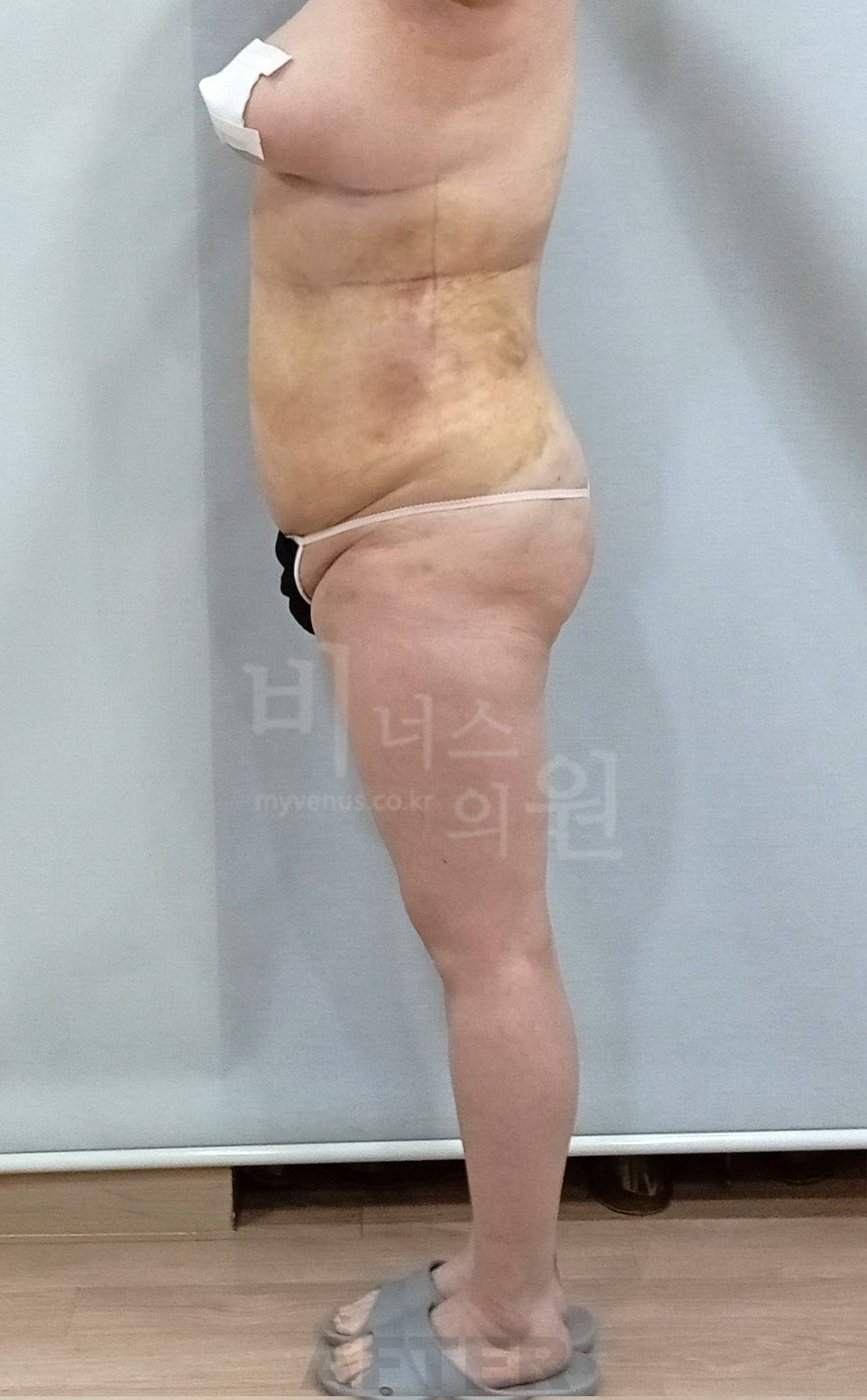 복부 허리 엉덩이 지방흡입 수술 후 우측면