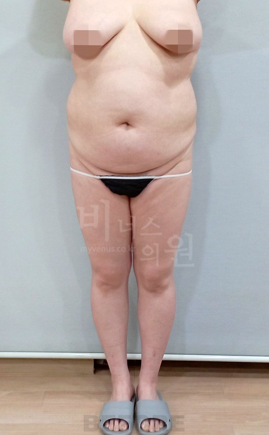 복부 허리 엉덩이 지방흡입 수술 전 정면