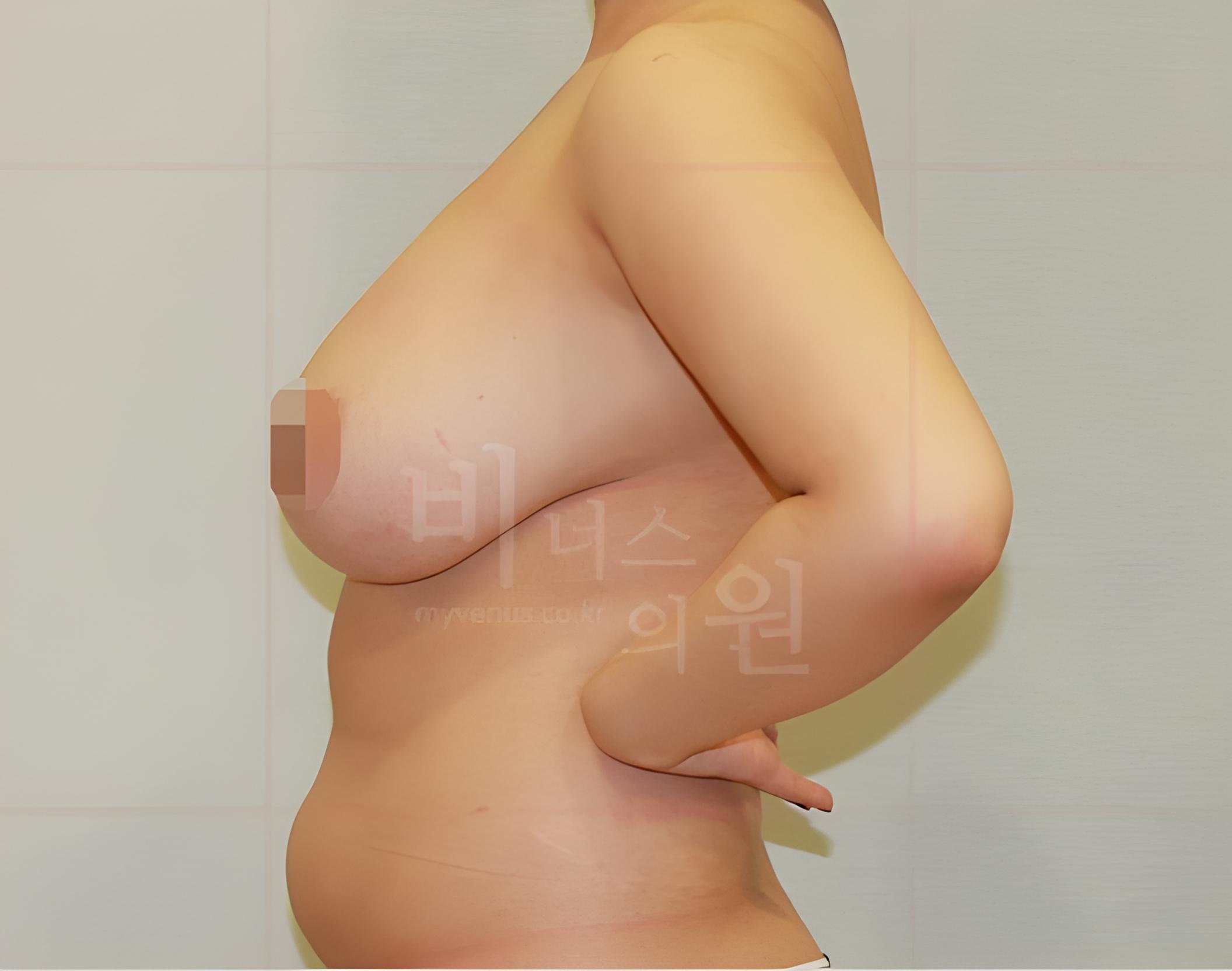 유방하수 가슴 지방흡입 수술 전 45도