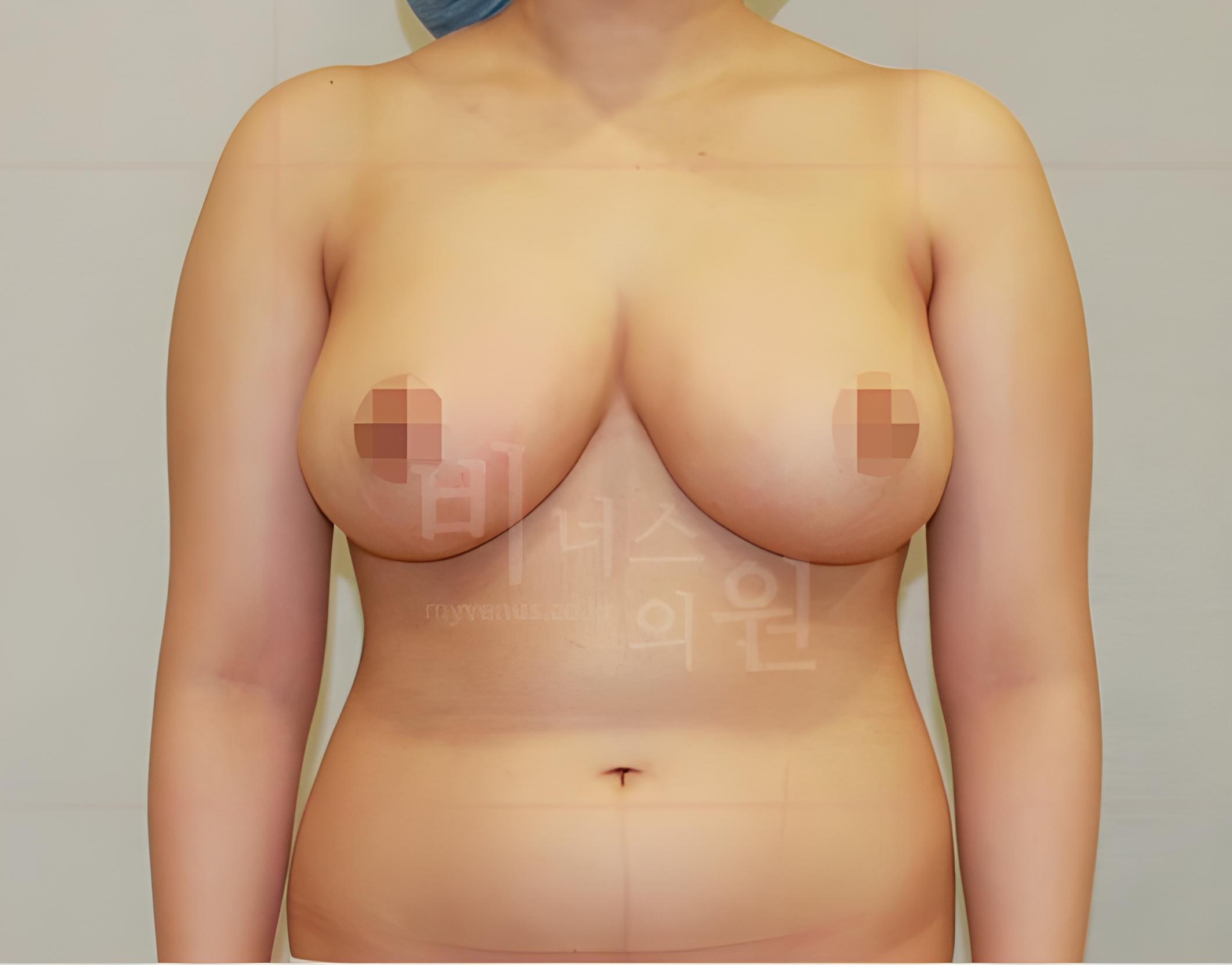 유방하수 가슴 지방흡입 수술 후 정면