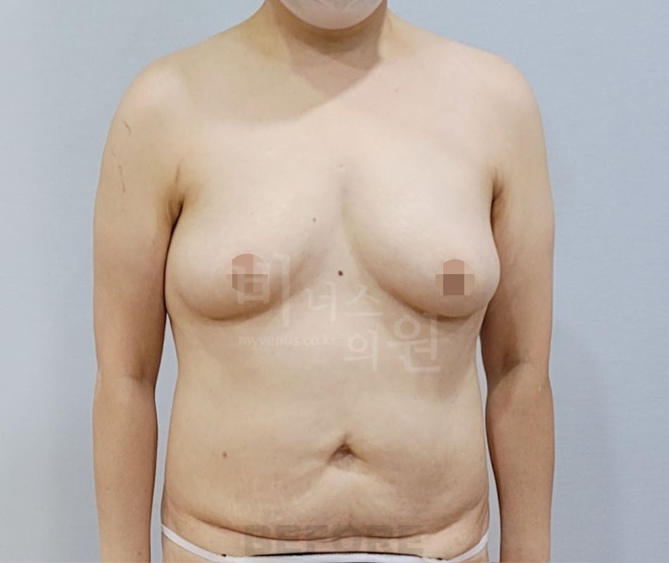 유방 부위 수술 전 정면