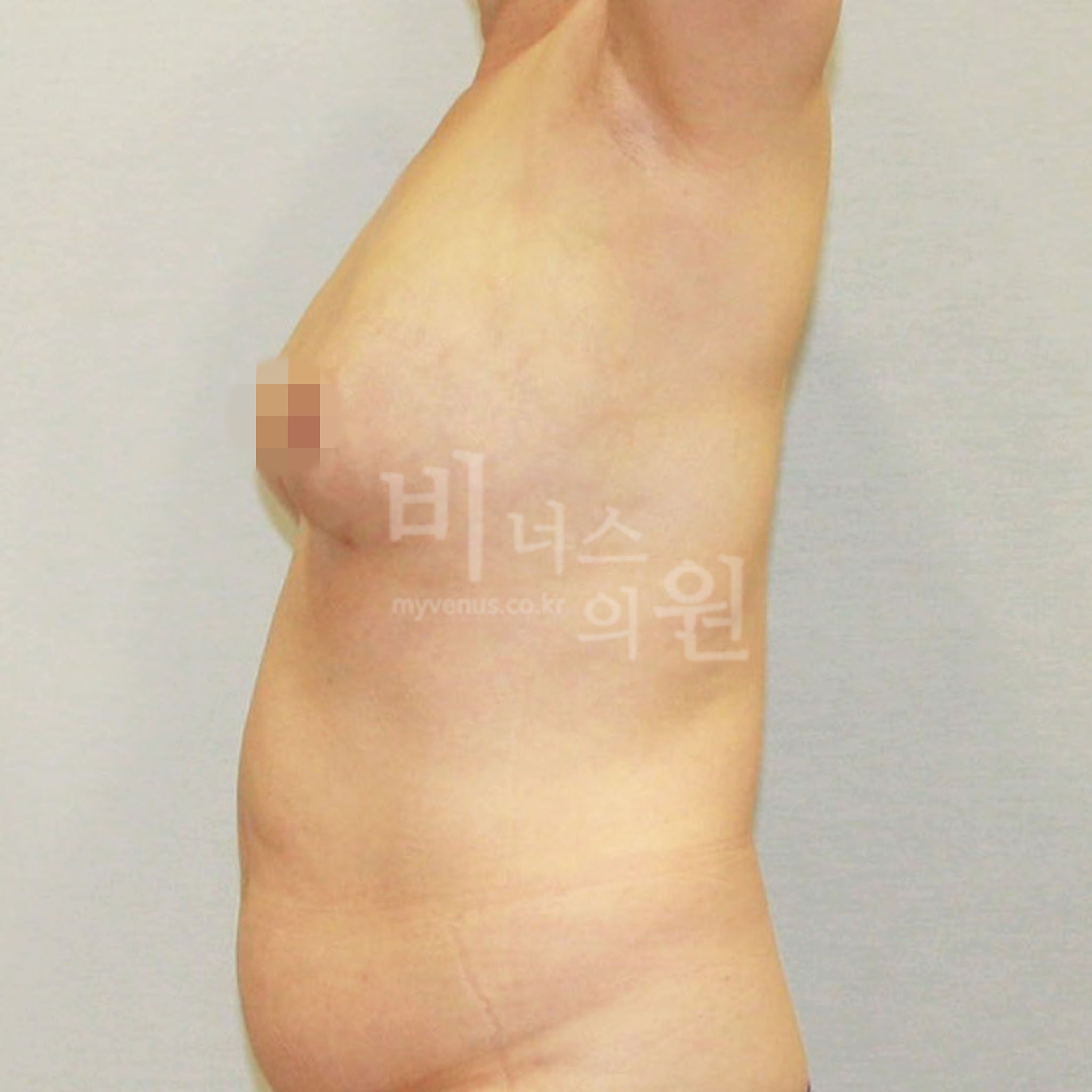 유방하수 가슴축소 지방흡입 수술 후 측면