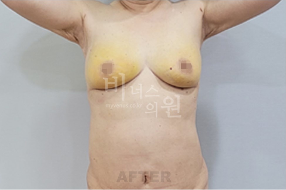 유방하수 가슴축소 지방흡입 수술 후 정면 팔 올림