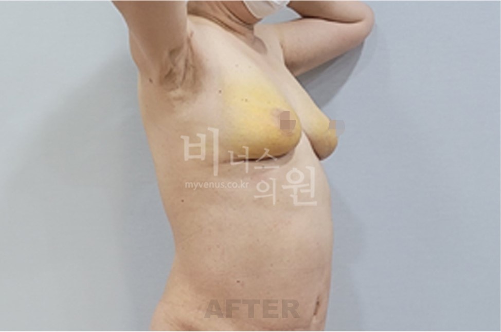 유방하수 가슴축소 지방흡입 수술 후 45도 측면 2