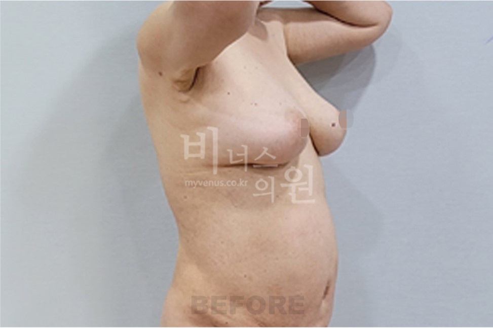 유방하수 가슴축소 지방흡입 수술 전 45도 측면 2