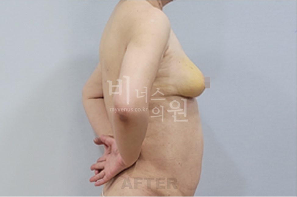 유방하수 가슴축소 지방흡입 수술 후 측면