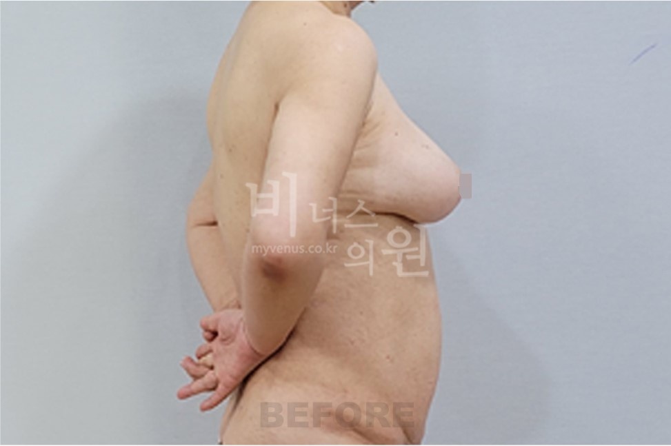 유방하수 가슴축소 지방흡입 수술 전 측면
