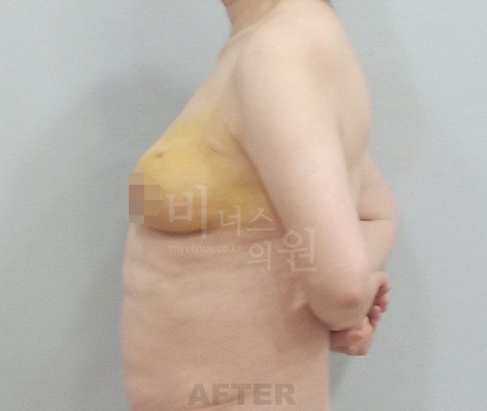 가슴축소 지방흡입 수술 후 우측면