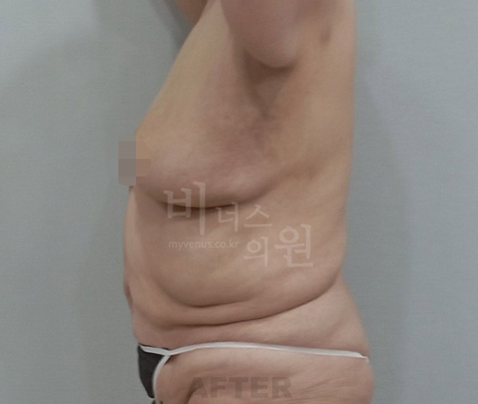 동일인 수술 후 측면 1
