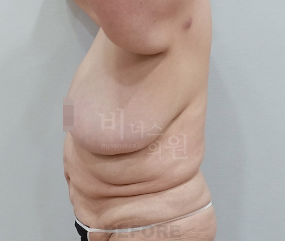 동일인 수술 전 측면 1