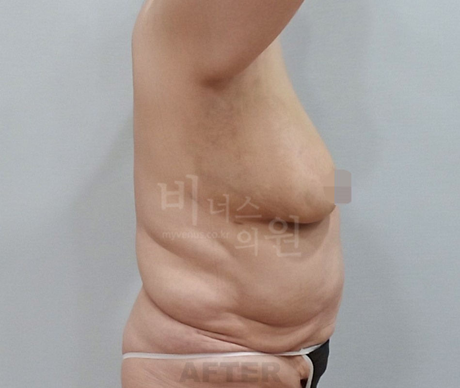 동일인 수술 후 측면 2
