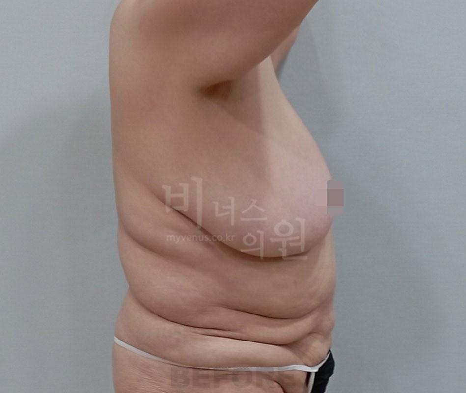 동일인 수술 전 측면 2