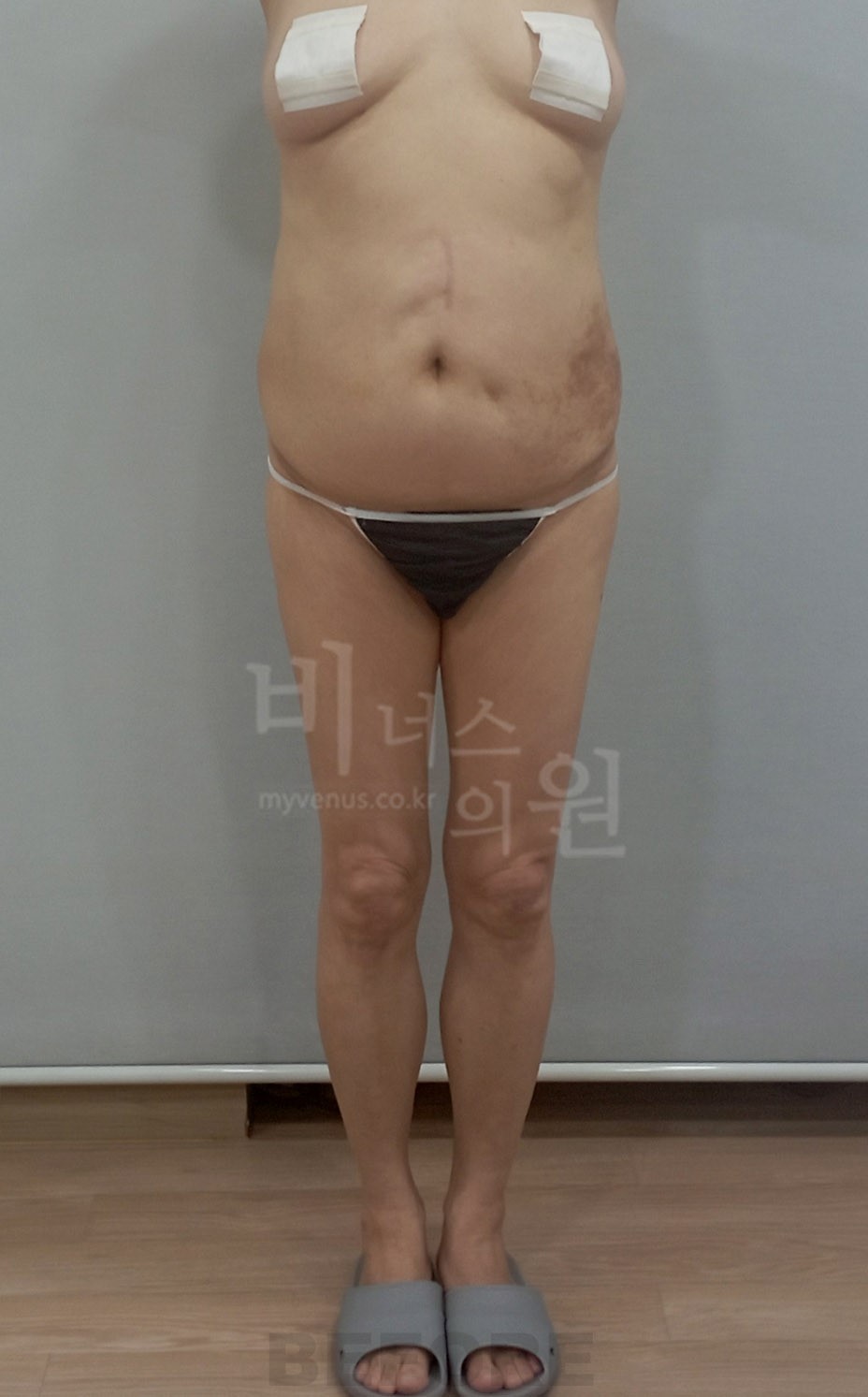 2024년 복부 지방흡입·엉덩이 지방이식 수술 전 정면 촬영