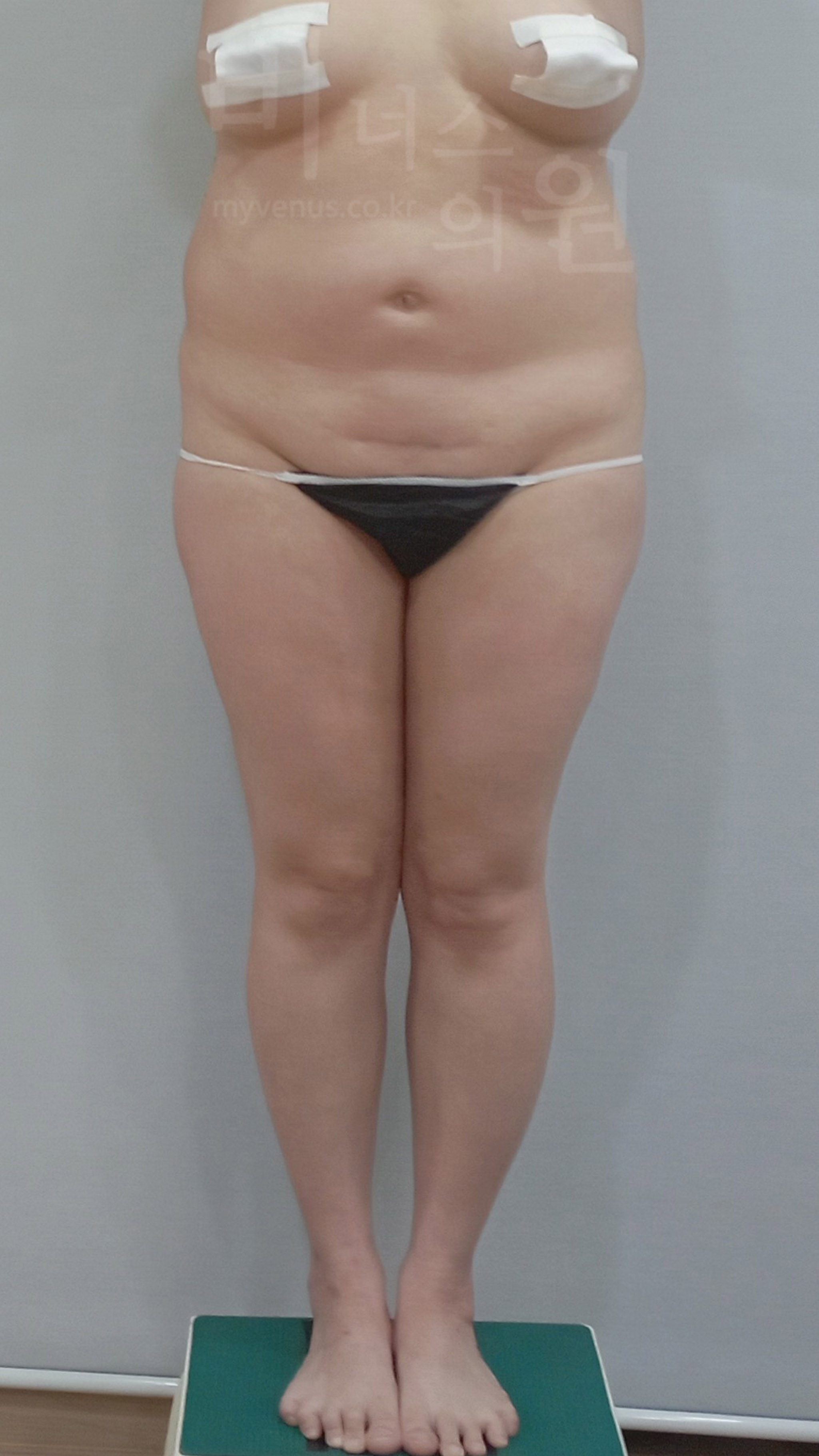 엉덩이처짐 지방흡입 수술 전 정면