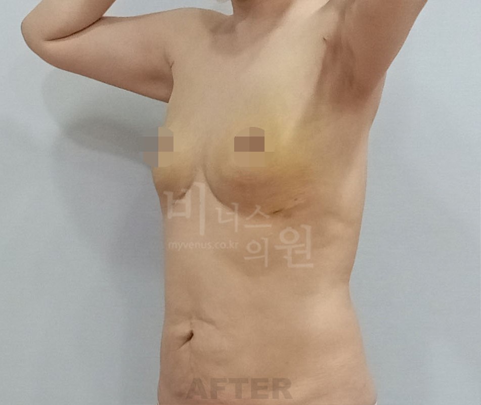 유방하수 표층 지방흡입 수술 후 45도 측면