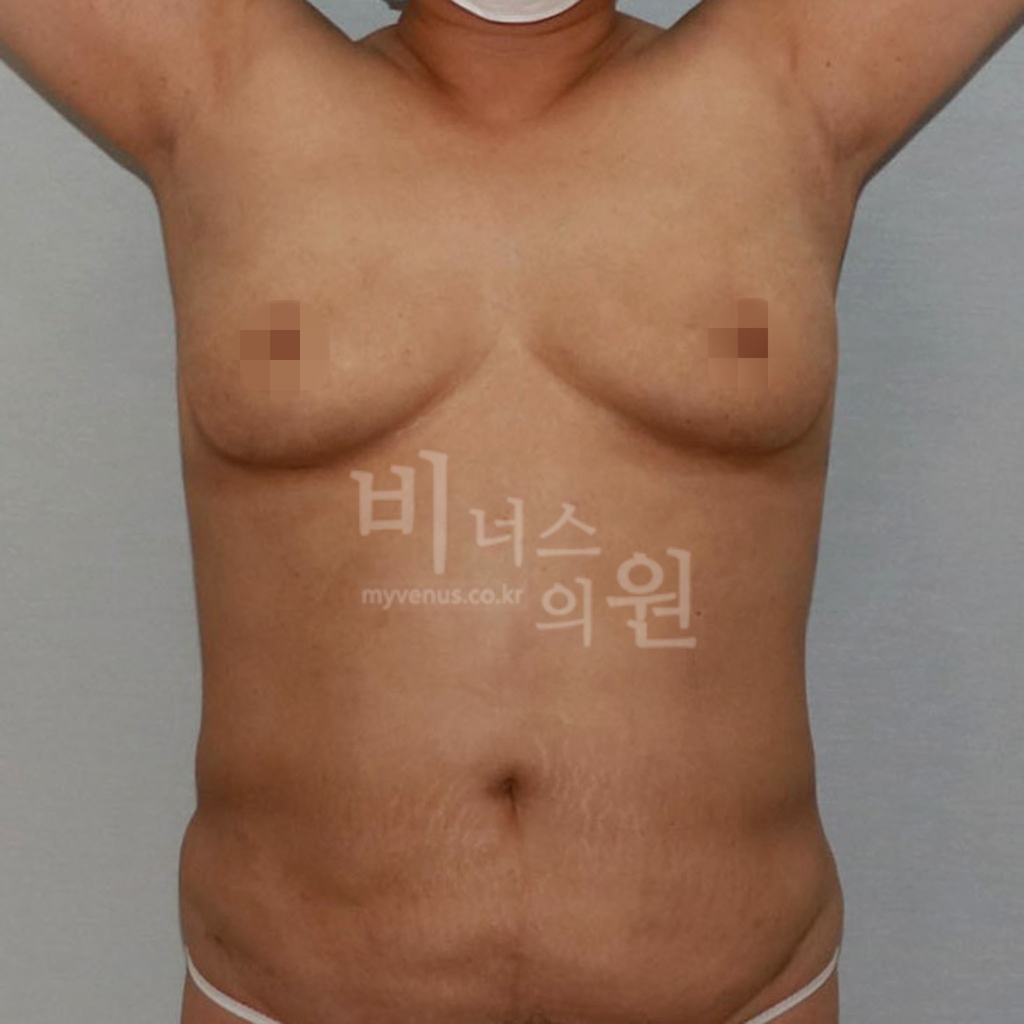 유방하수 표층 지방흡입 수술 후 정면