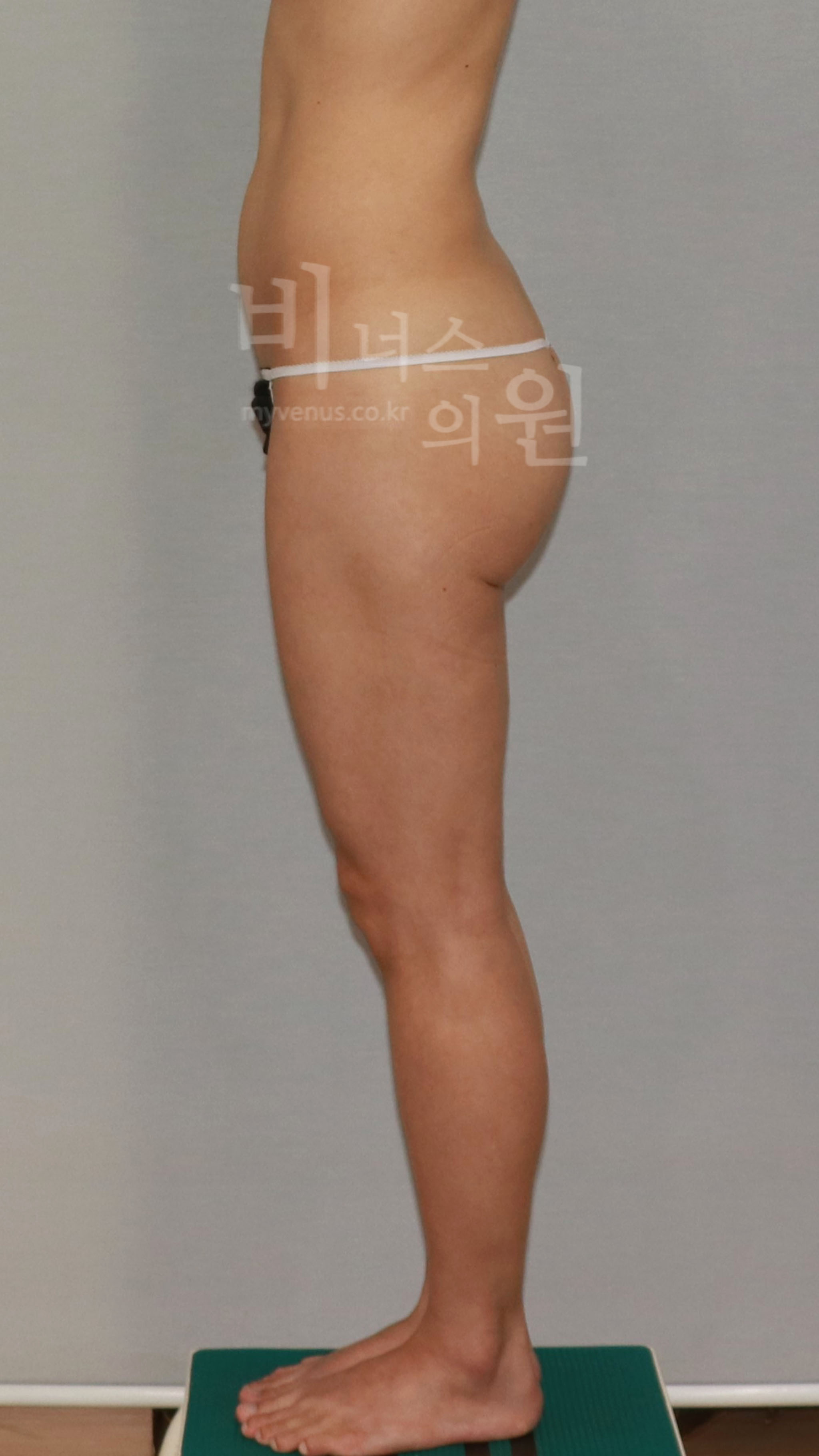 엉덩이처짐 지방흡입 수술 전 측면 사진