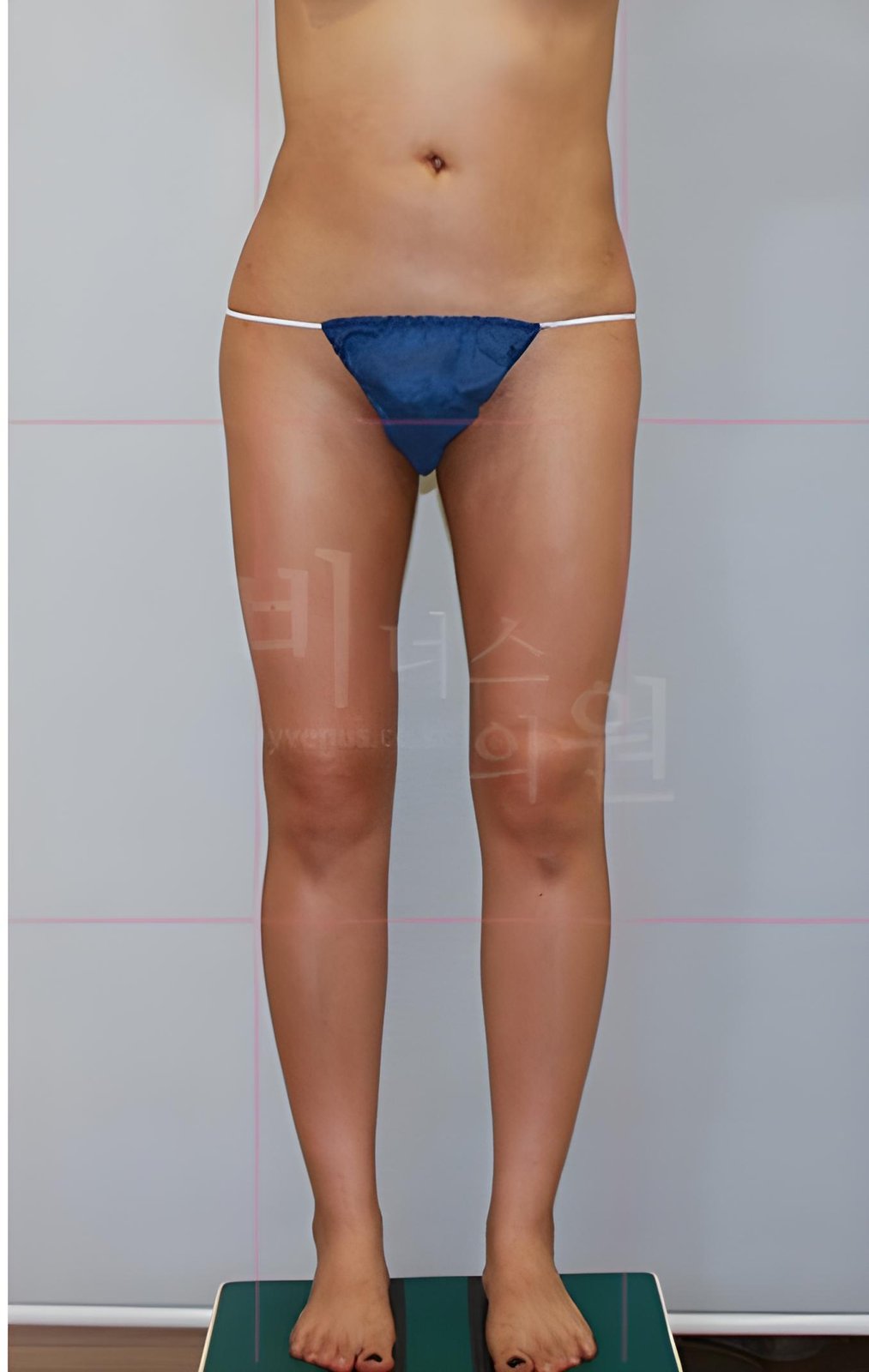엉덩이축소 지방흡입 재수술 정면 수술 후