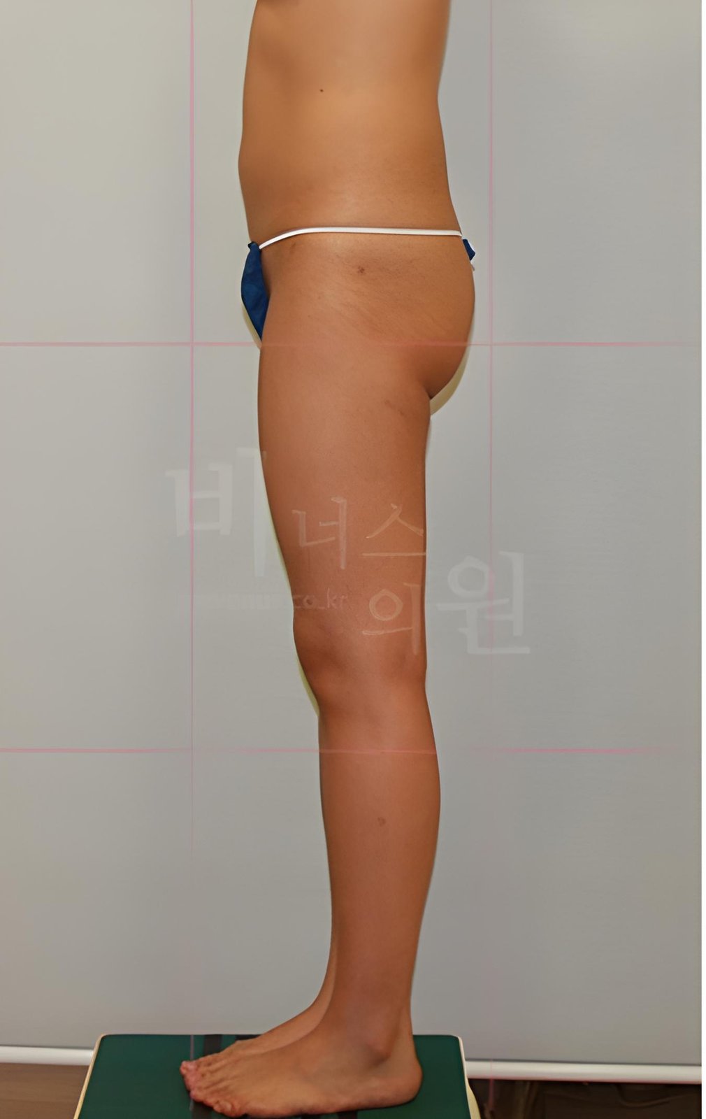 엉덩이축소 지방흡입 재수술 측면 수술 전