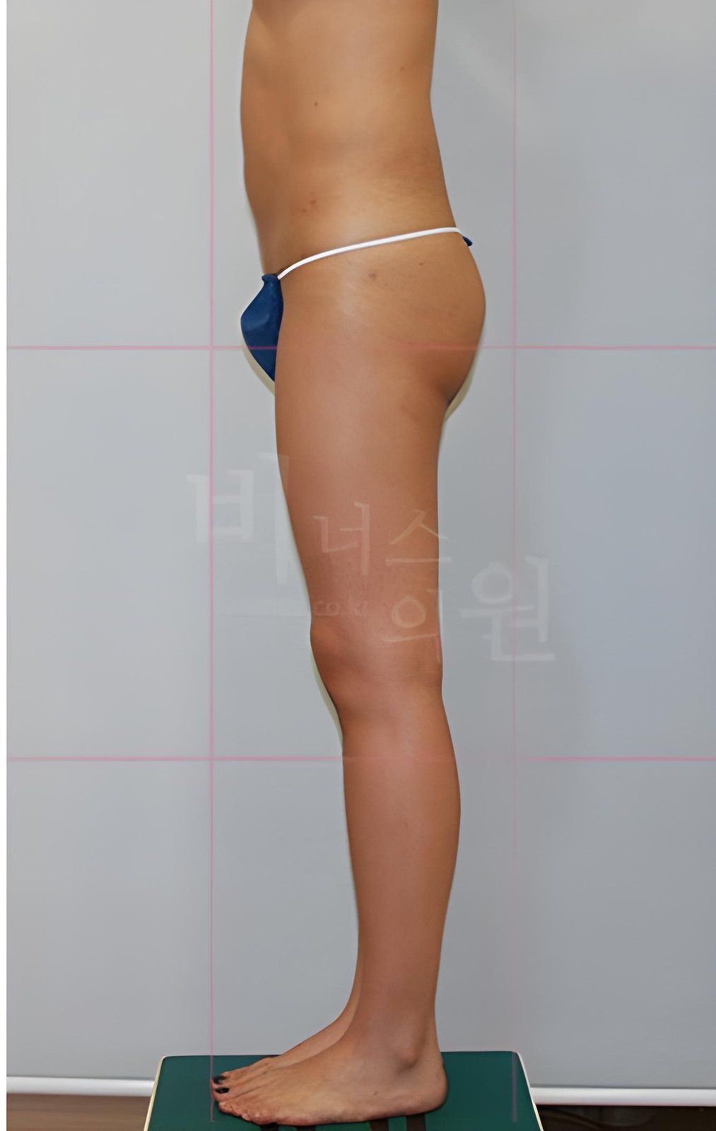 엉덩이축소 지방흡입 재수술 측면 수술 후