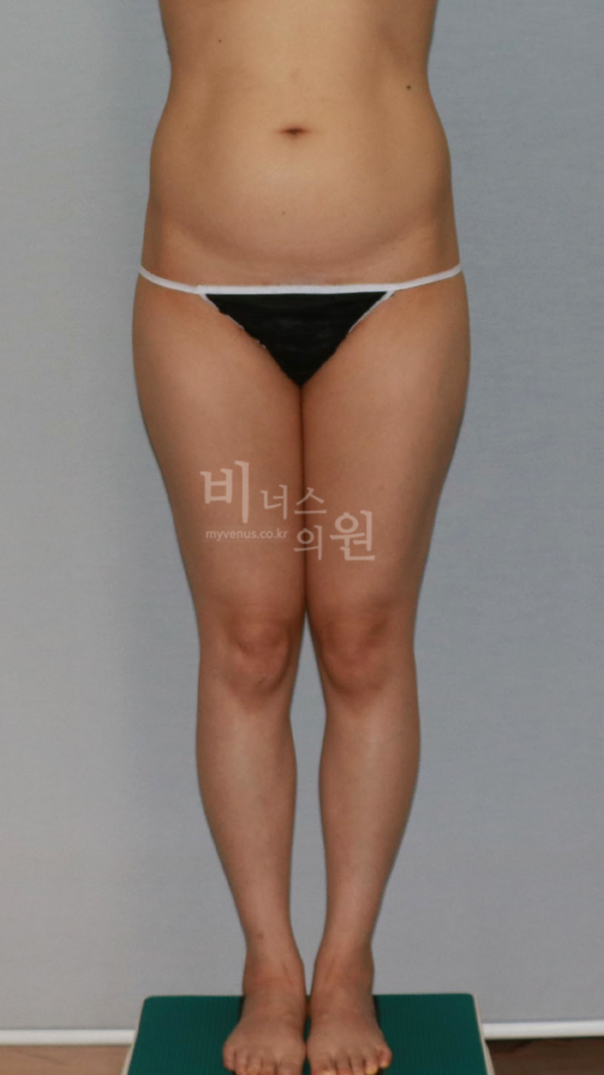 엉덩이축소 정면 수술 전 비너스의원