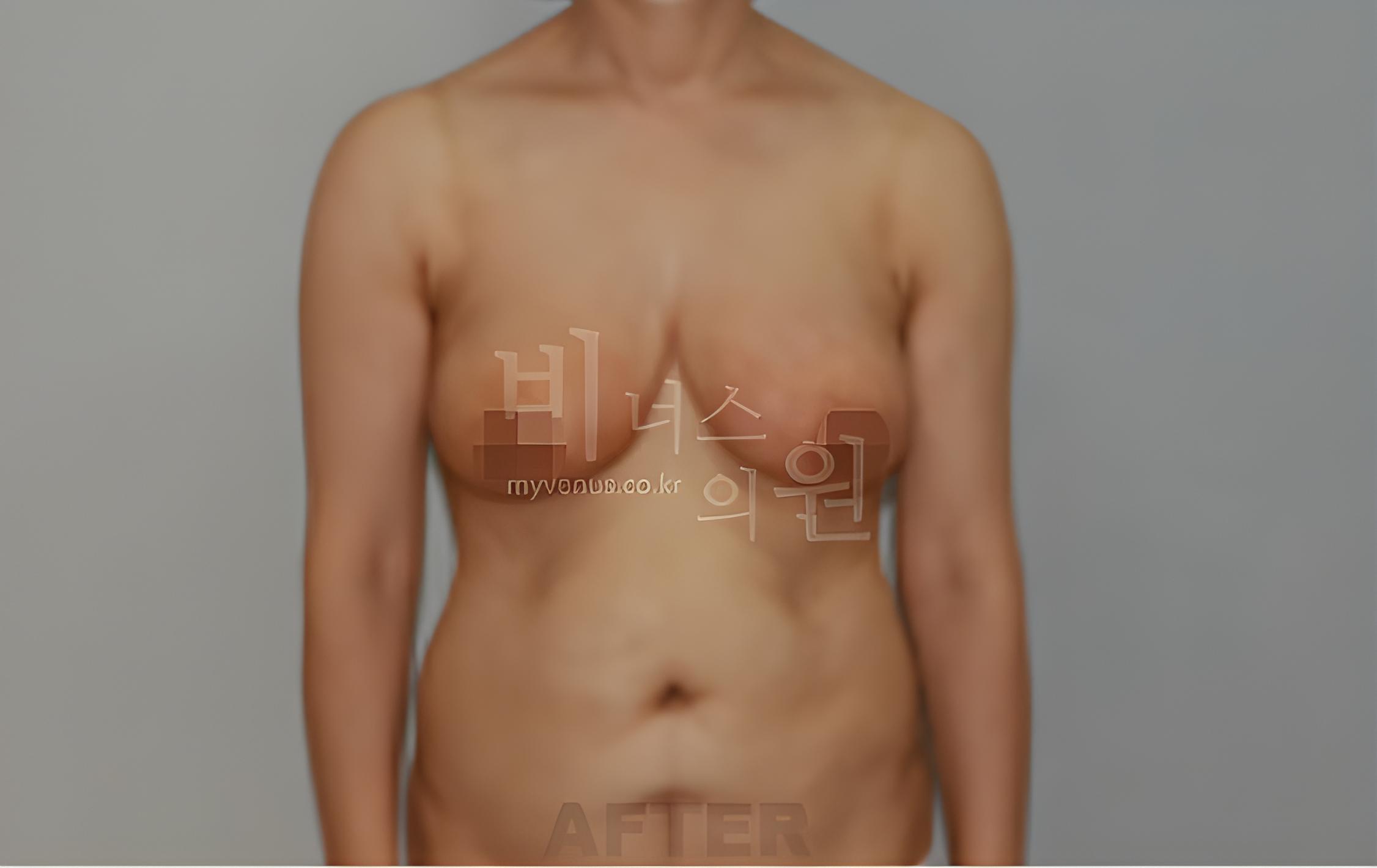 유방하수 표층 지방흡입 수술 후 정면