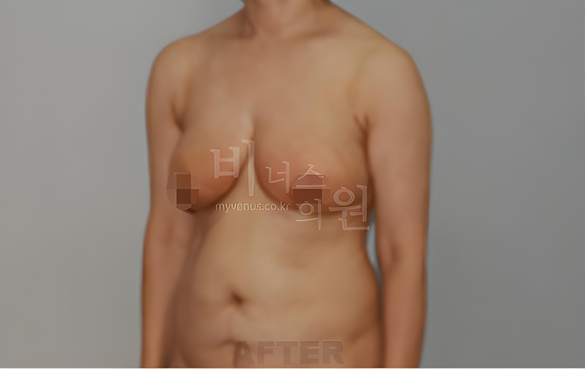 유방하수 표층 지방흡입 수술 후 45도