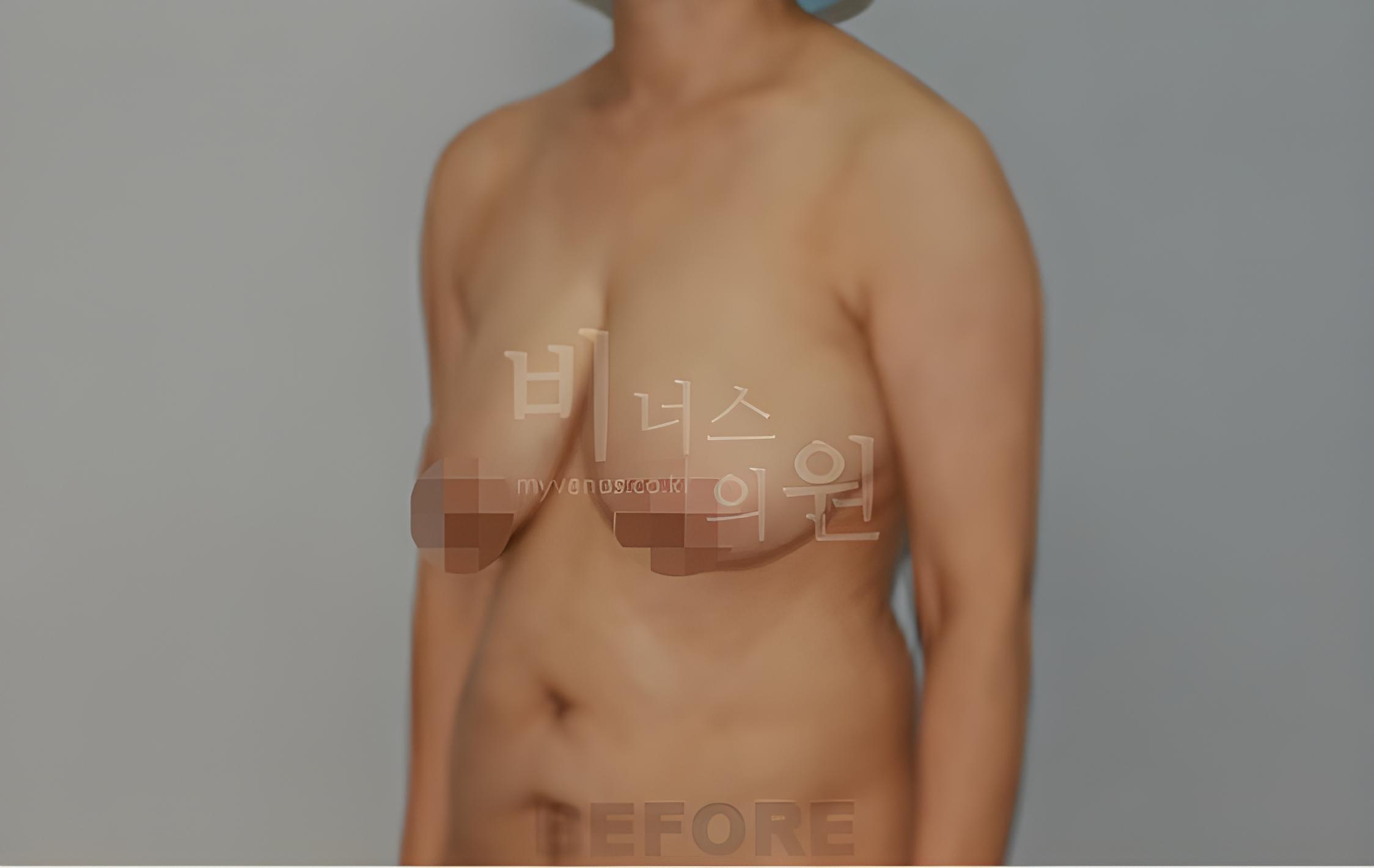 유방하수 표층 지방흡입 수술 전 45도