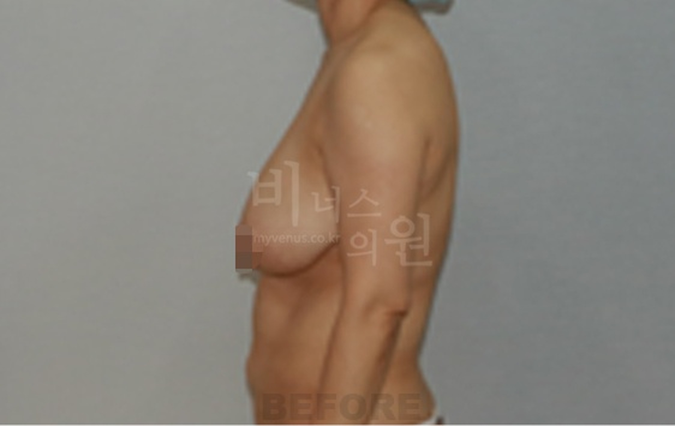 유방하수 표층 지방흡입 수술 전 측면