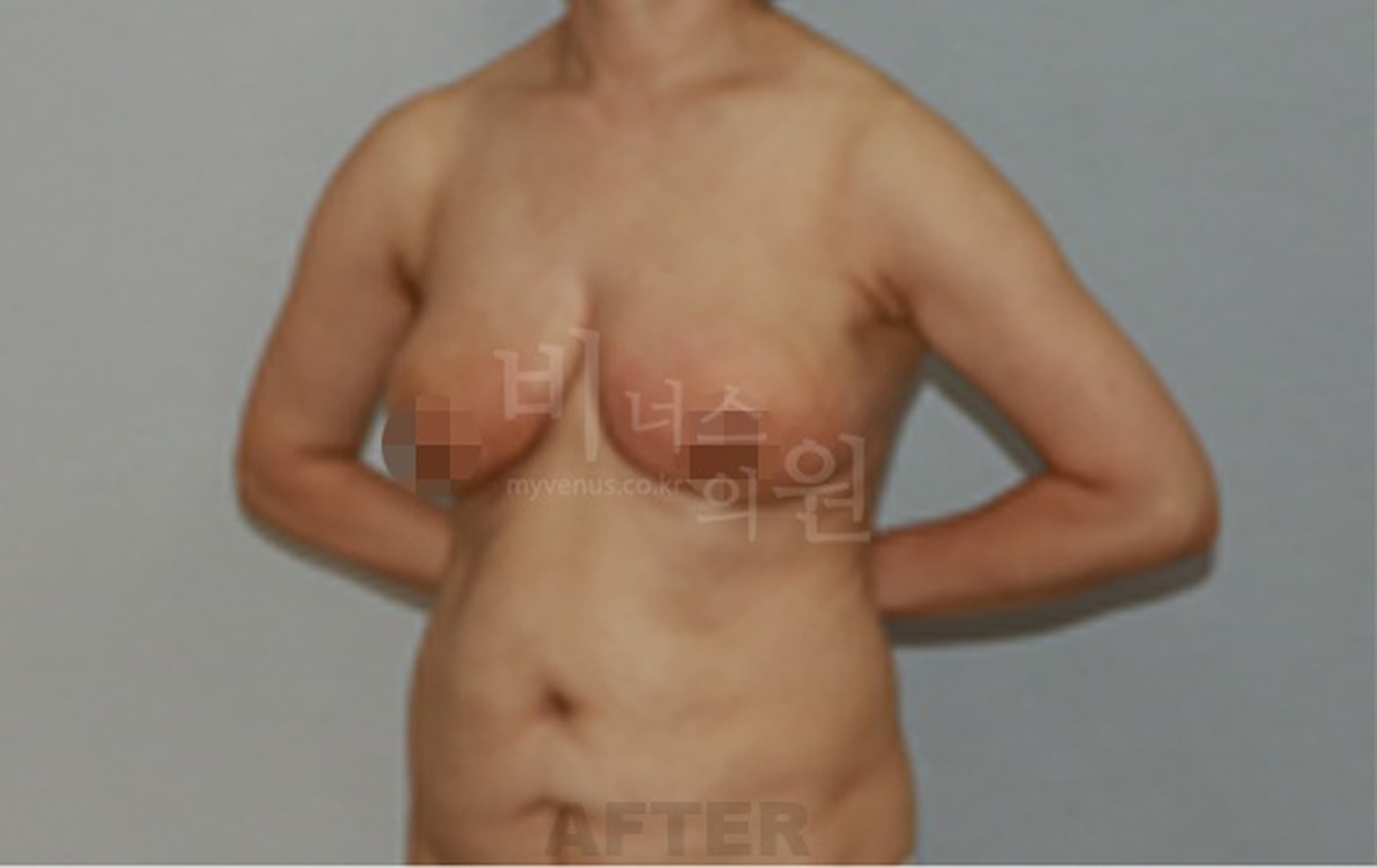 유방하수 표층 지방흡입 수술 후 45도 각도 사진