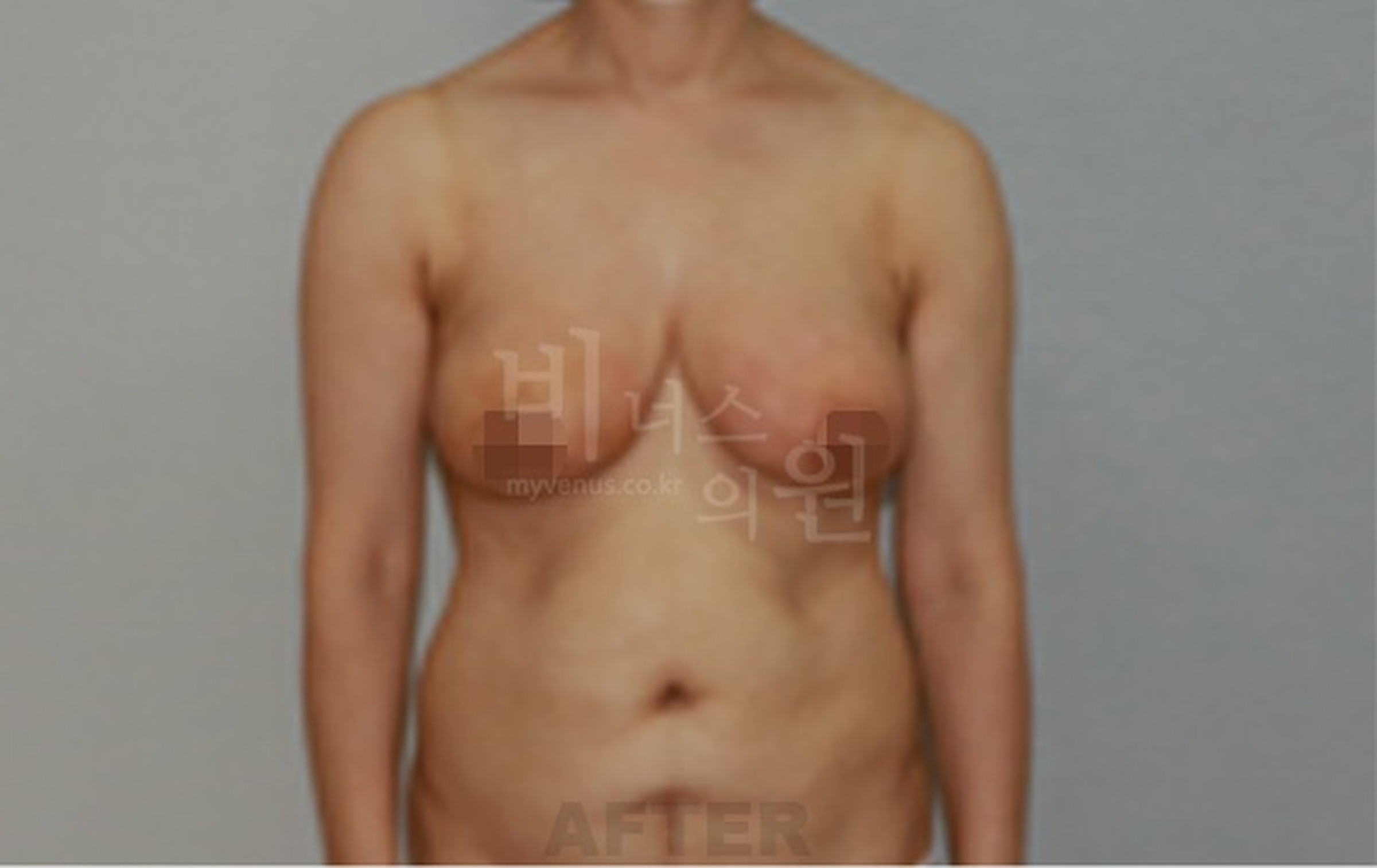유방하수 표층 지방흡입 수술 후 정면 사진
