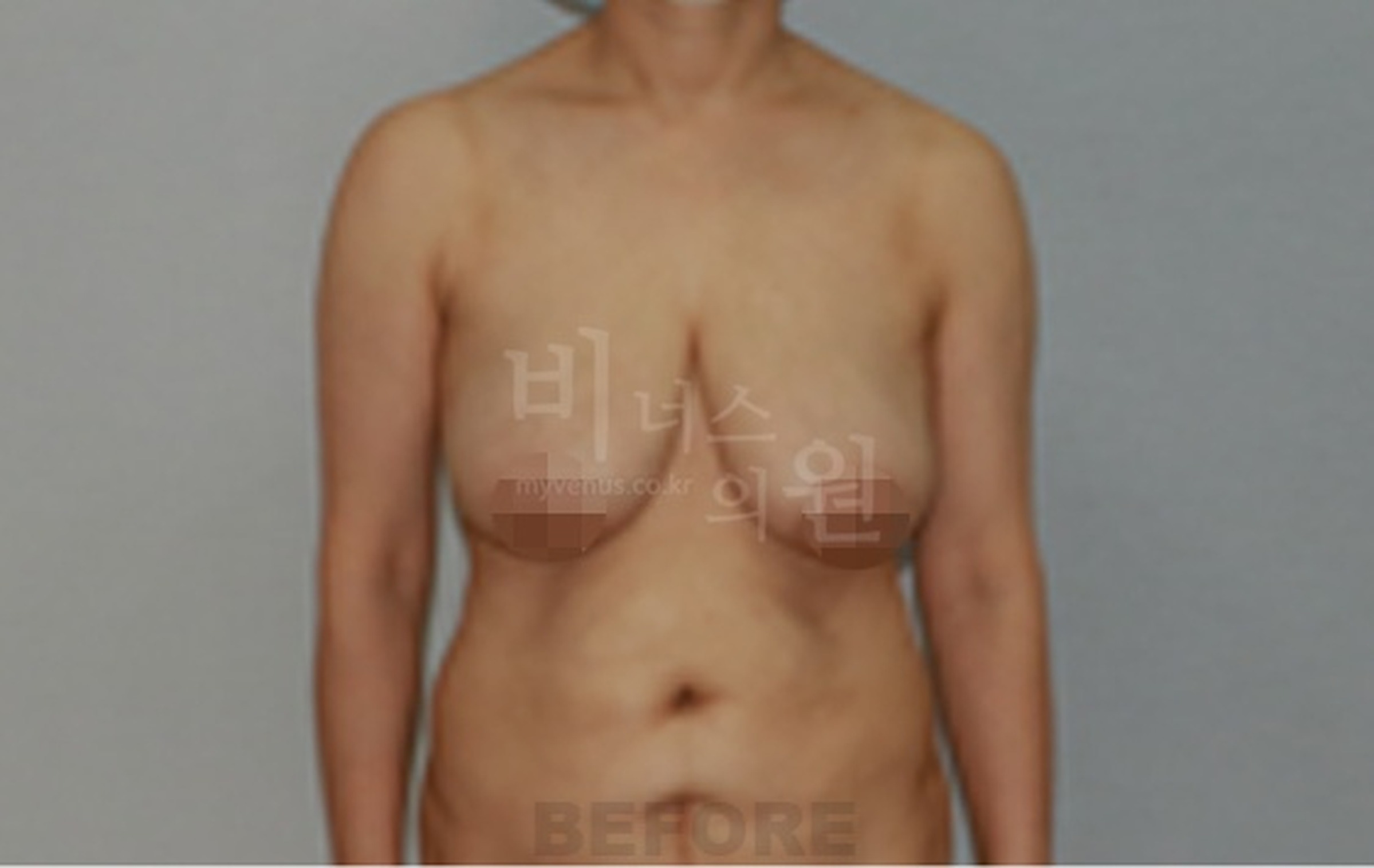 유방하수 표층 지방흡입 수술 전 정면 사진