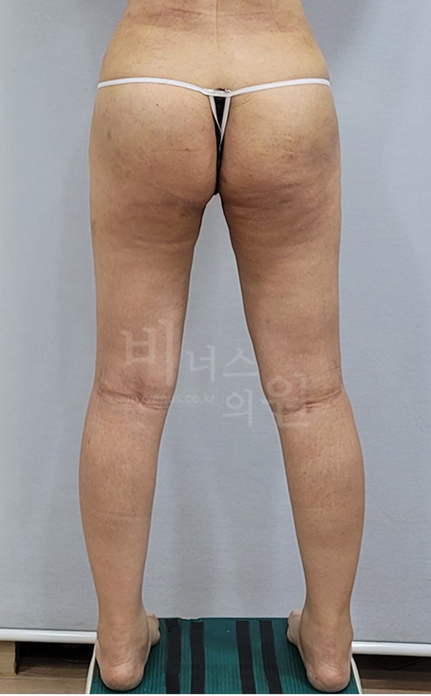 엉덩이축소 지방흡입 수술 후 후면