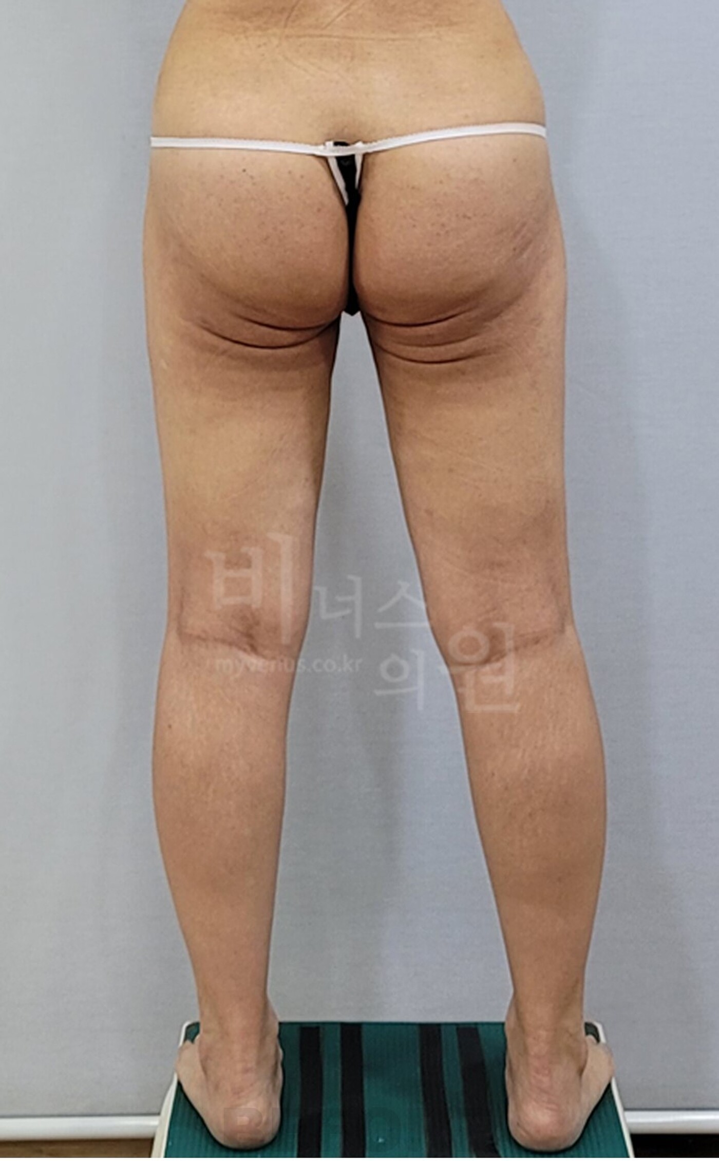 엉덩이축소 지방흡입 수술 전 후면