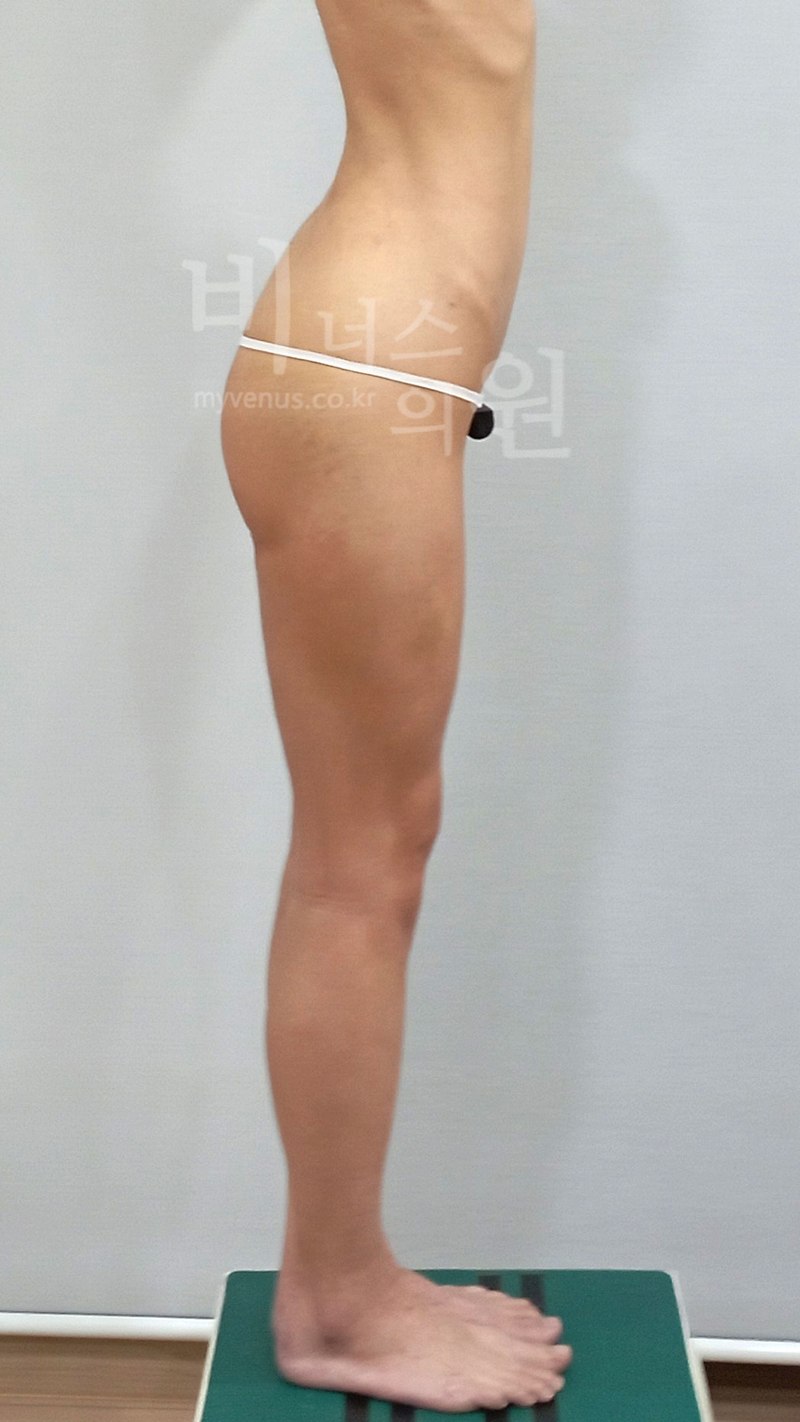 엉덩이축소 재수술 측면 수술 후