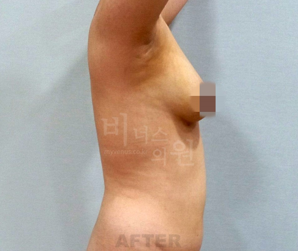 유방하수 표층 지방흡입 시술 후 측면 2