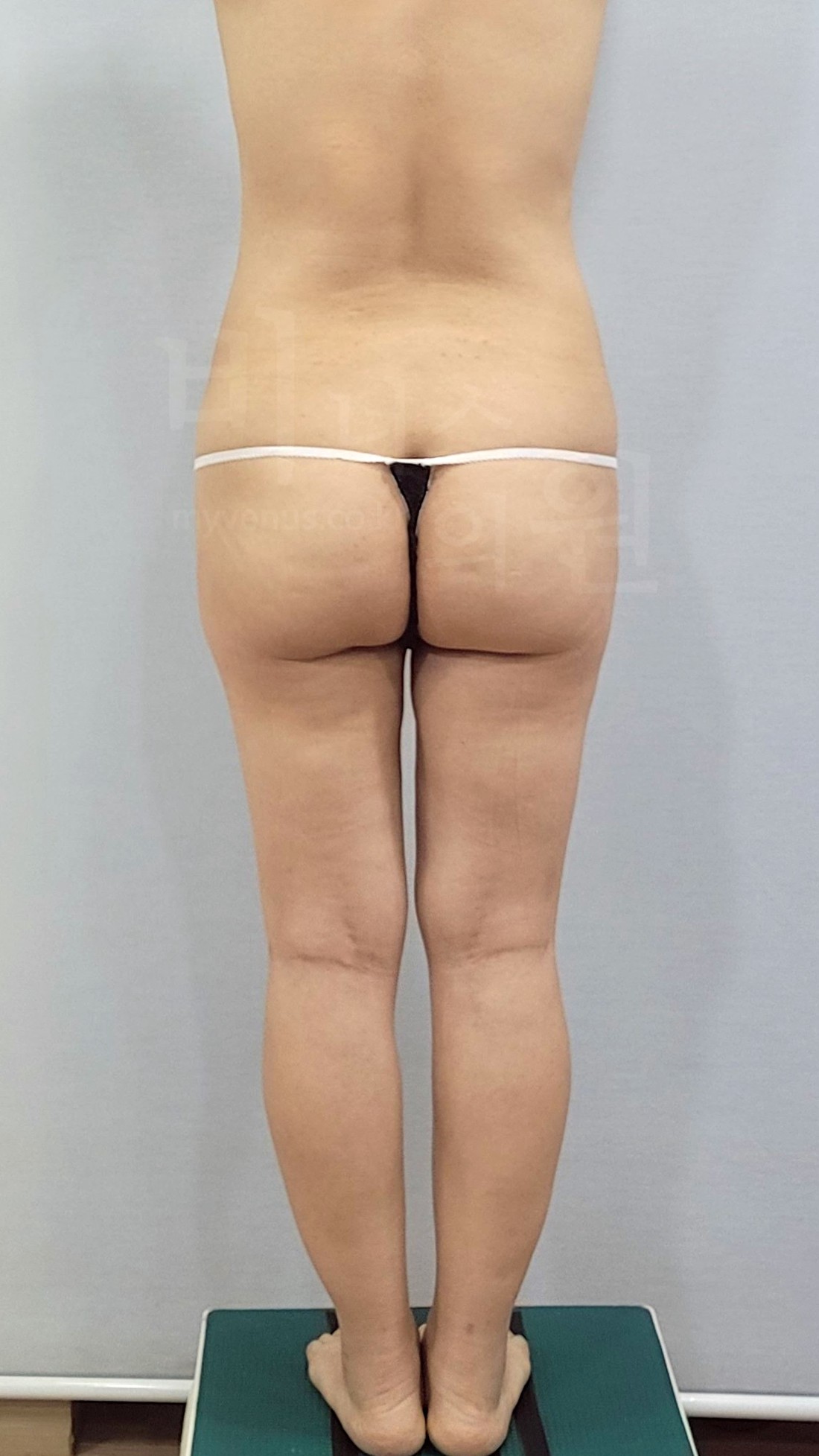 엉덩이축소 지방흡입 수술 전 후면 사진 2025년 촬영