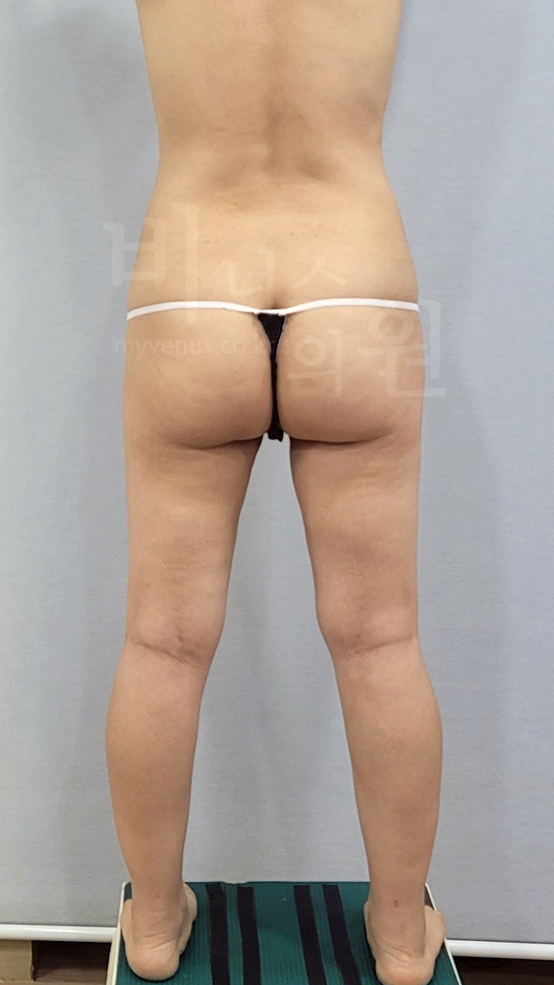 엉덩이축소 지방흡입 수술 전 후면 사진 2025년 촬영