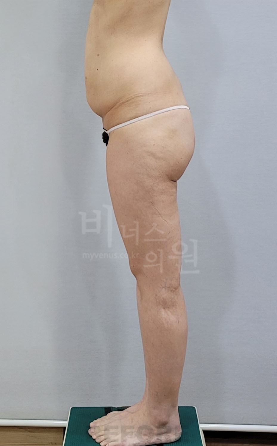 엉덩이축소 지방흡입 수술 전 측면 사진