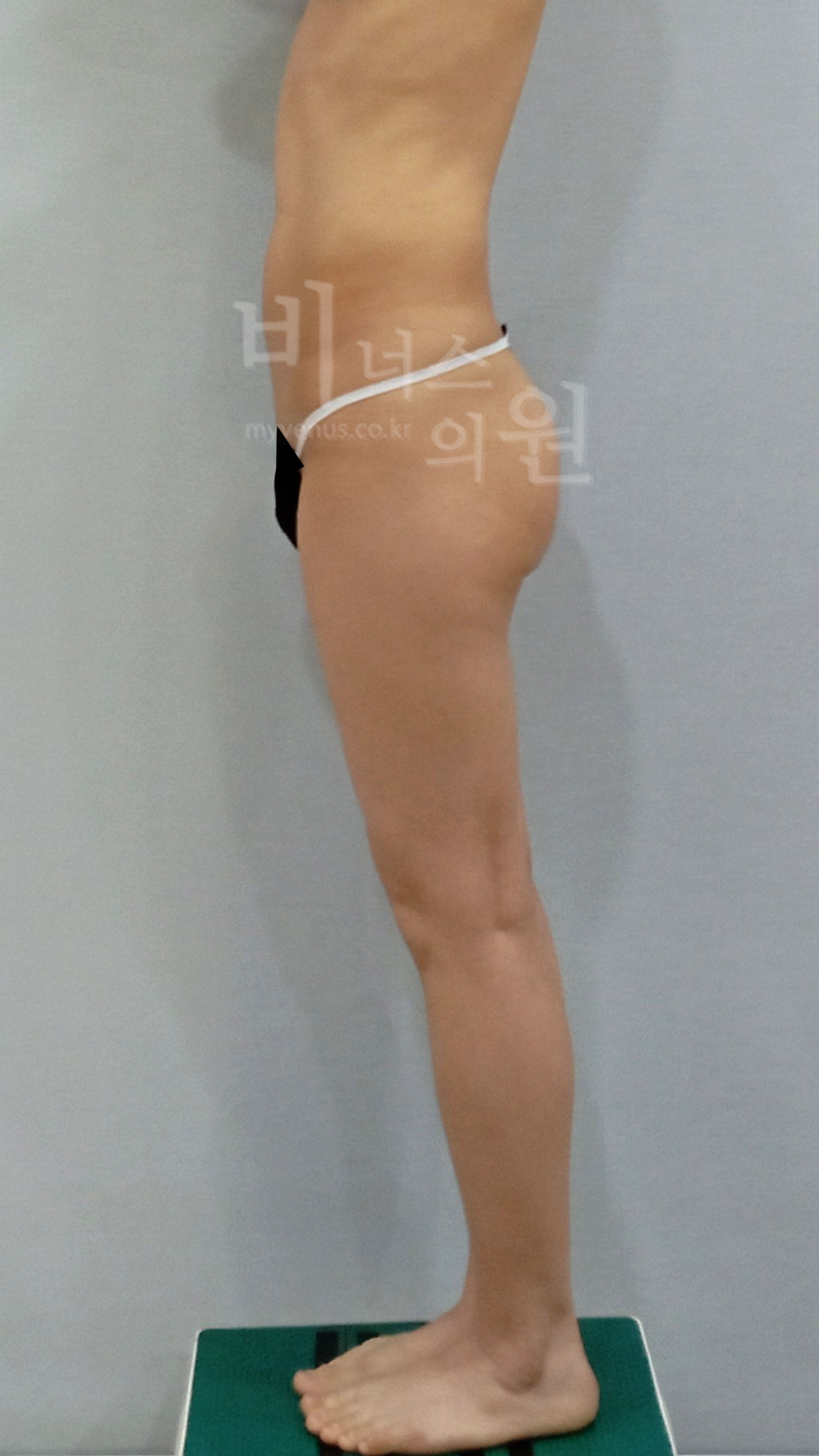 엉덩이축소 지방흡입 관련 사례 사진 3