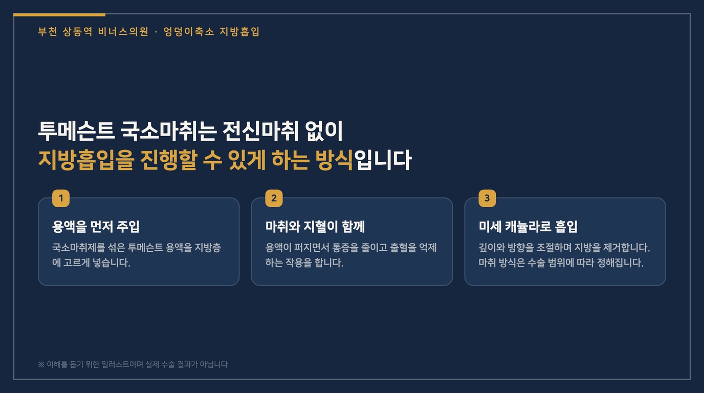 투메슨트 국소마취 지방흡입 3단계 일러스트