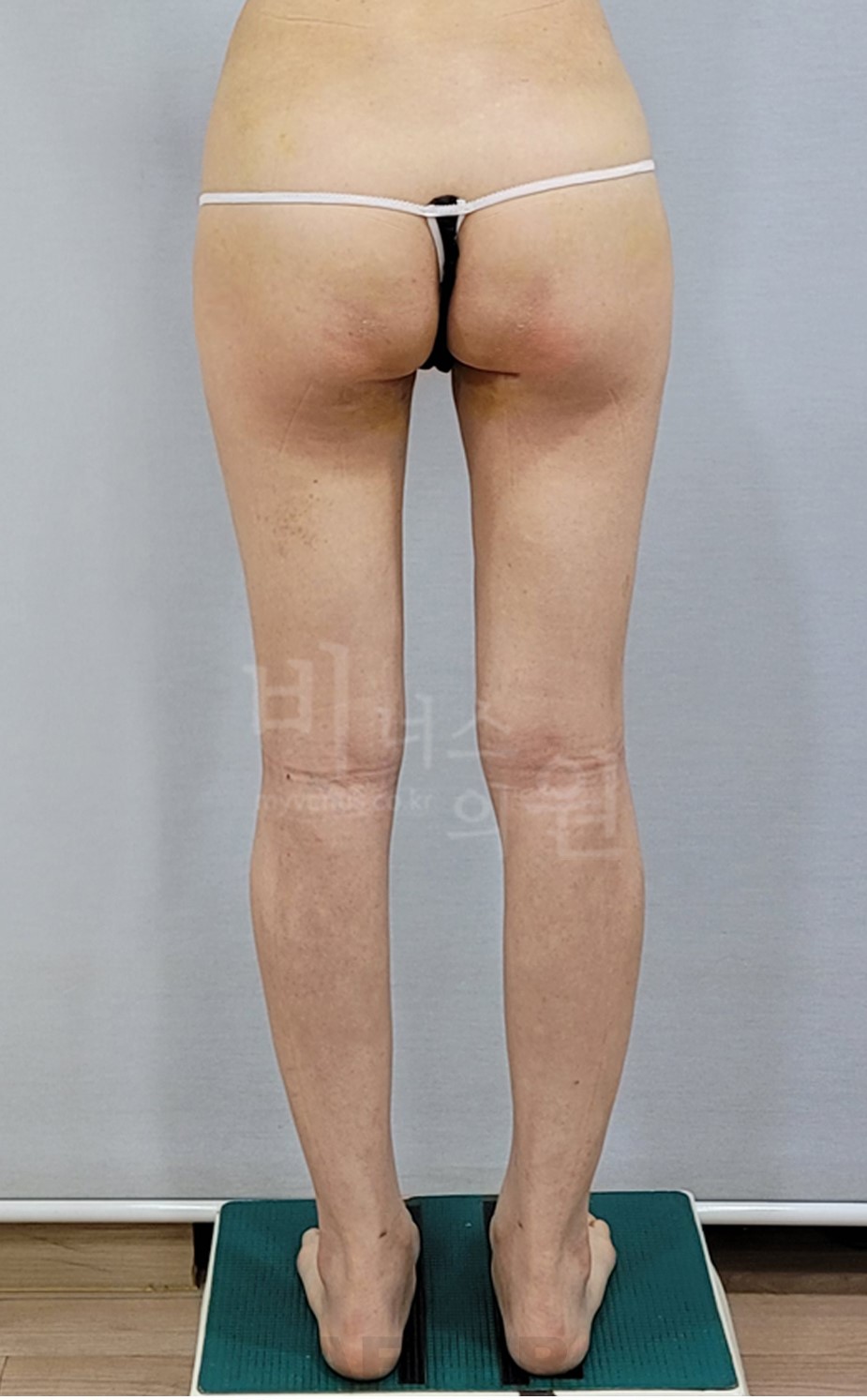 엉덩이축소 지방흡입 수술 후 후면 사진